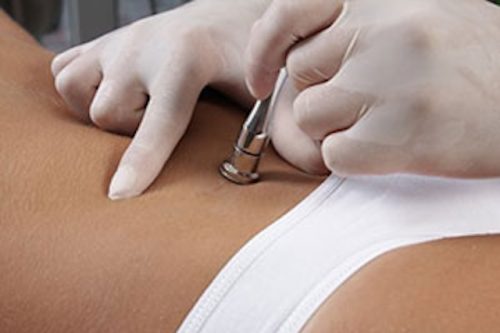 microdermabrasion